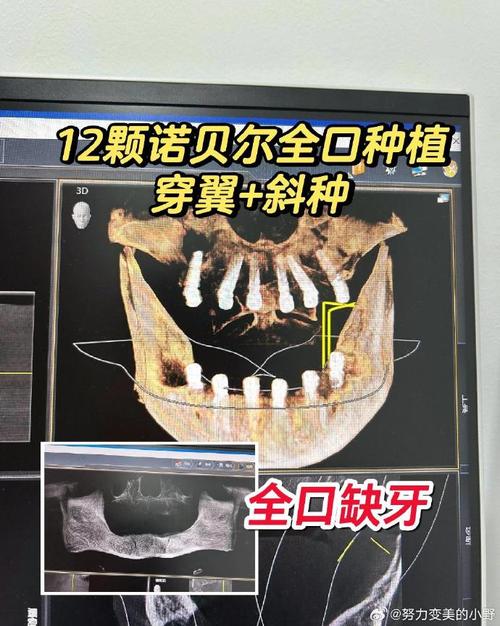 种植牙歪斜是什么原因导致的?该如何处理和预防?-图2 种植牙歪斜是什么原因导致的?该如何处理和预防?-图2