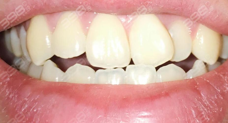 种植牙歪斜是什么原因导致的?该如何处理和预防?-图3 种植牙歪斜是什么原因导致的?该如何处理和预防?-图3