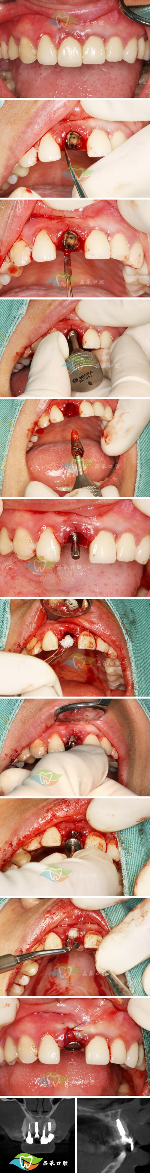 微创种植牙图片大全能展示哪些关键信息？-图3