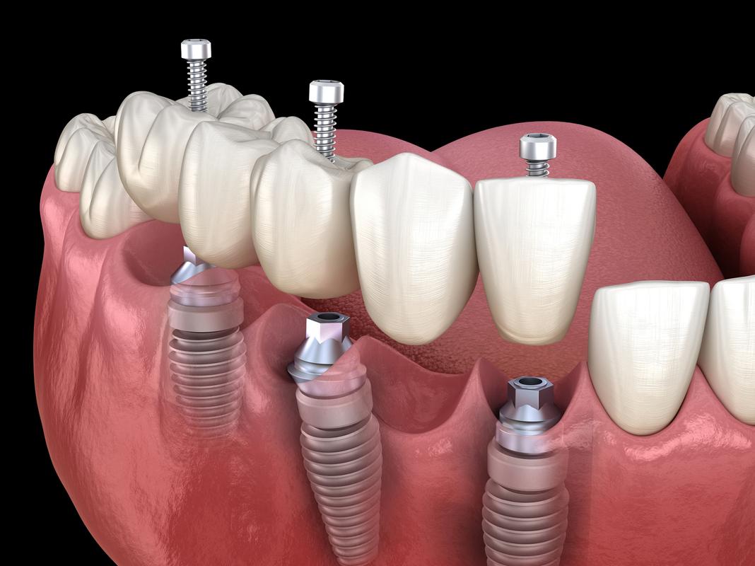 微创种植牙图片大全能展示哪些关键信息?-图1 微创种植牙图片大全能展示哪些关键信息?-图1