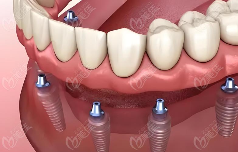 微创种植牙效果好不好-图2