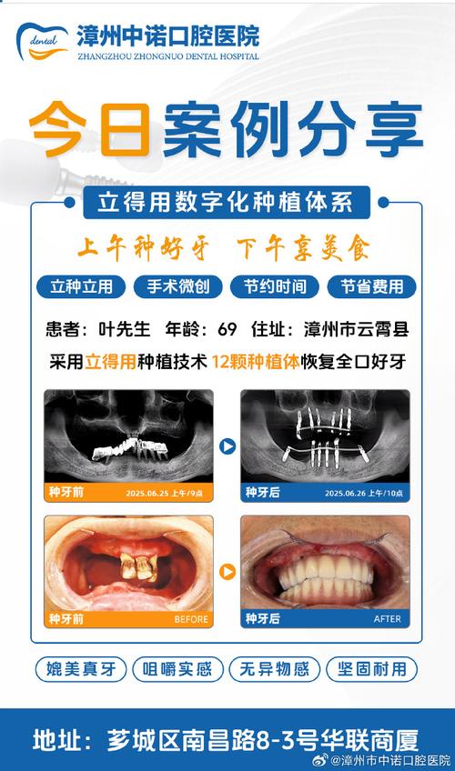 微创种植牙效果好不好-图3