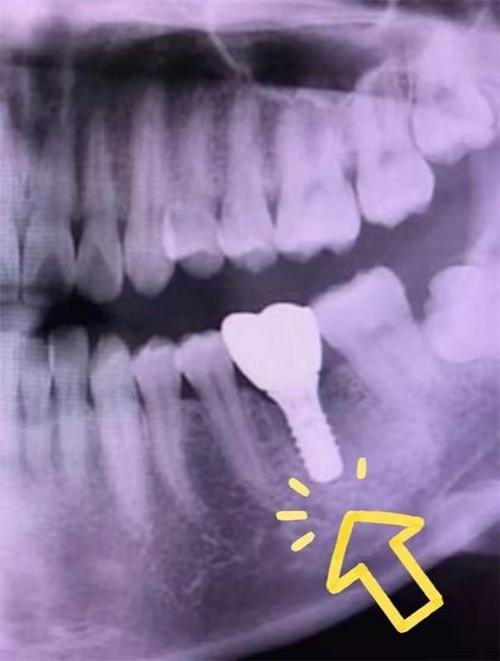 上海最早开展种植牙手术的具体时间是什么时候？-图3