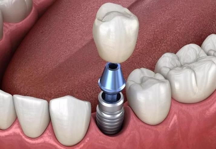 四川免费种植牙政策靠谱吗？申请条件和注意事项有哪些？-图2