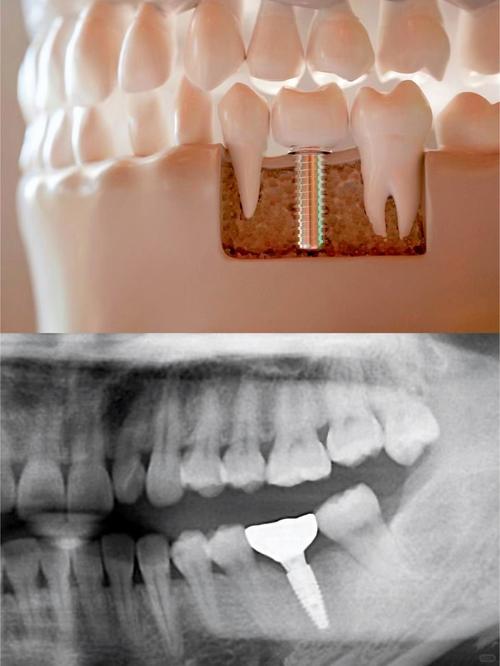 种植牙必须杀牙神经吗？哪些情况需要，哪些不用？-图1