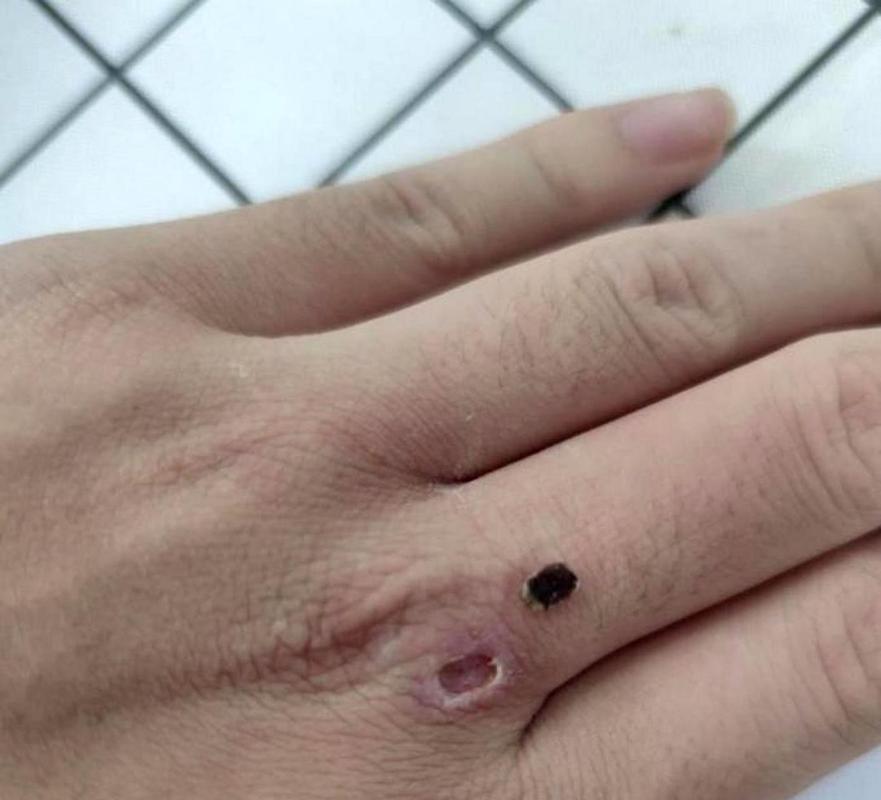 种植牙后有血痂正常吗?需注意哪些护理事项?-图2 种植牙后有血痂正常吗?需注意哪些护理事项?-图2