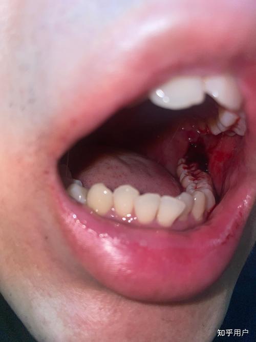 种植牙后有血痂正常吗？需注意哪些护理事项？-图3