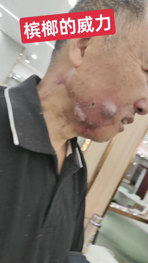 种植牙后引起口腔癌-图1 种植牙后引起口腔癌-图1