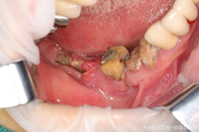 种植牙后引起口腔癌-图3 种植牙后引起口腔癌-图3