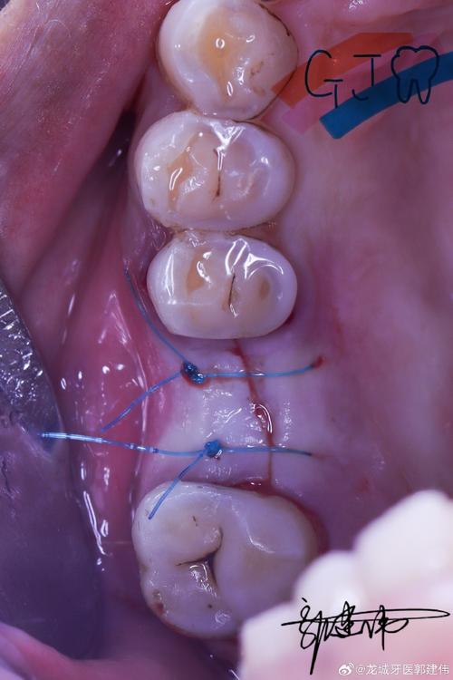 太原红十字口腔种植牙效果好不好？价格贵不贵？到底值不值得选呢？-图2