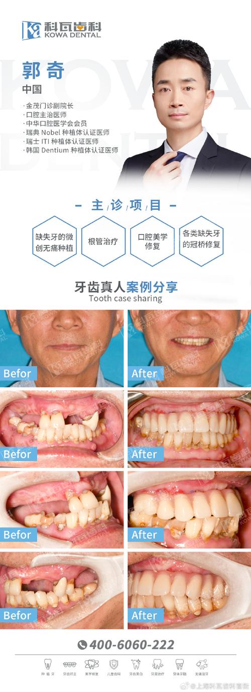 种植牙会影响脸型吗-图3 种植牙会影响脸型吗-图3
