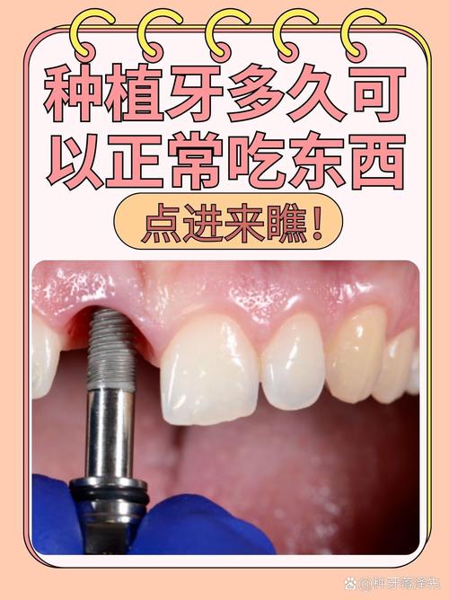 种植牙为何选德伦？效果技术与价格如何？-图3