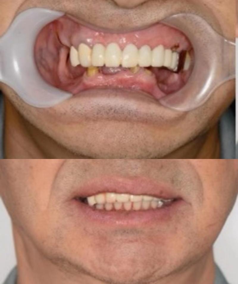 种植欧美牙技术有哪些独特优势?效果与传统种植牙相比如何?-图2 种植欧美牙技术有哪些独特优势?效果与传统种植牙相比如何?-图2