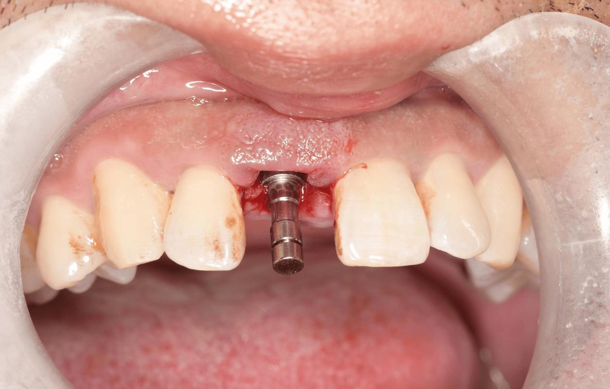 日本为何停止种植牙？背后原因引热议-图2