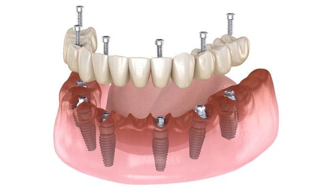 种植牙纯钛材料好吗？安全耐用吗？-图3