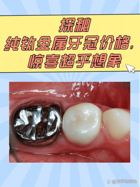 种植牙纯钛材料好吗？安全耐用吗？-图1