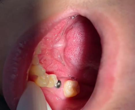 种植牙二期切-图2 种植牙二期切-图2