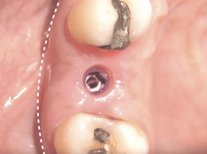 种植牙二期切-图1 种植牙二期切-图1