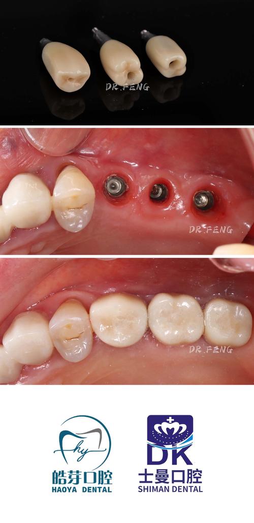 鞍山种植牙价格多少?效果怎么样?医院怎么选才靠谱?要注意什么?-图3 鞍山种植牙价格多少?效果怎么样?医院怎么选才靠谱?要注意什么?-图3