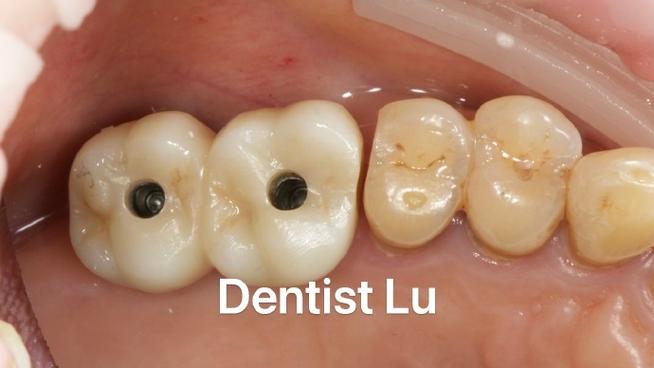 种植牙为何容易食物塞嵌？日常护理要注意什么？-图1