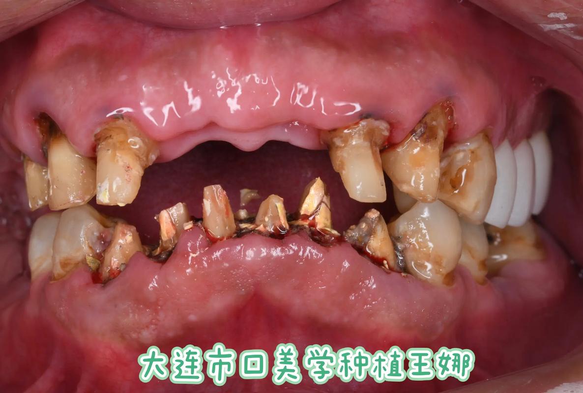 大连种植牙加工的流程、技术及质量如何全面把控？-图3