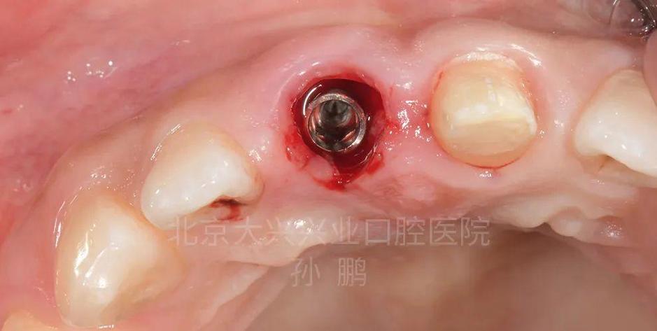 牙前区种植修复效果如何?关键技术与注意事项有哪些?-图3 牙前区种植修复效果如何?关键技术与注意事项有哪些?-图3