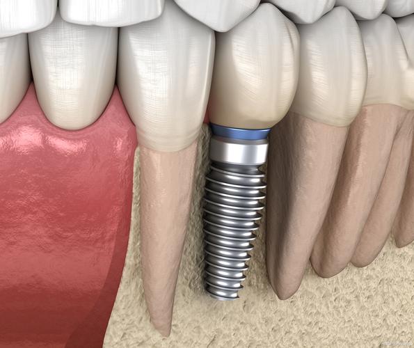 种植牙是口腔治疗的什么方式?有哪些优势与适应症?-图1 种植牙是口腔治疗的什么方式?有哪些优势与适应症?-图1