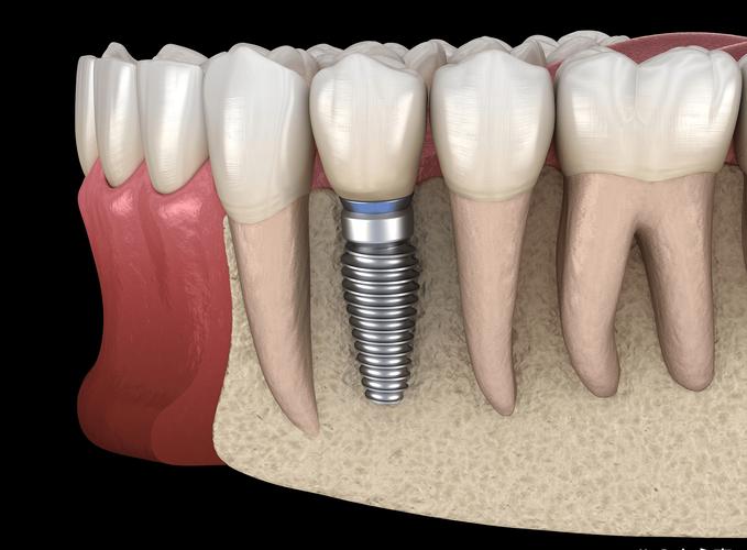 种植牙戴上后出现晃动,是种植体失败还是护理问题?该怎么处理?-图1 种植牙戴上后出现晃动,是种植体失败还是护理问题?该怎么处理?-图1