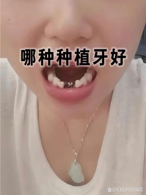 呼市种植牙哪好-图3