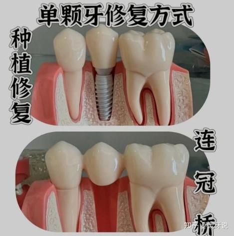 种植牙选哪种品牌和材质更好？-图1