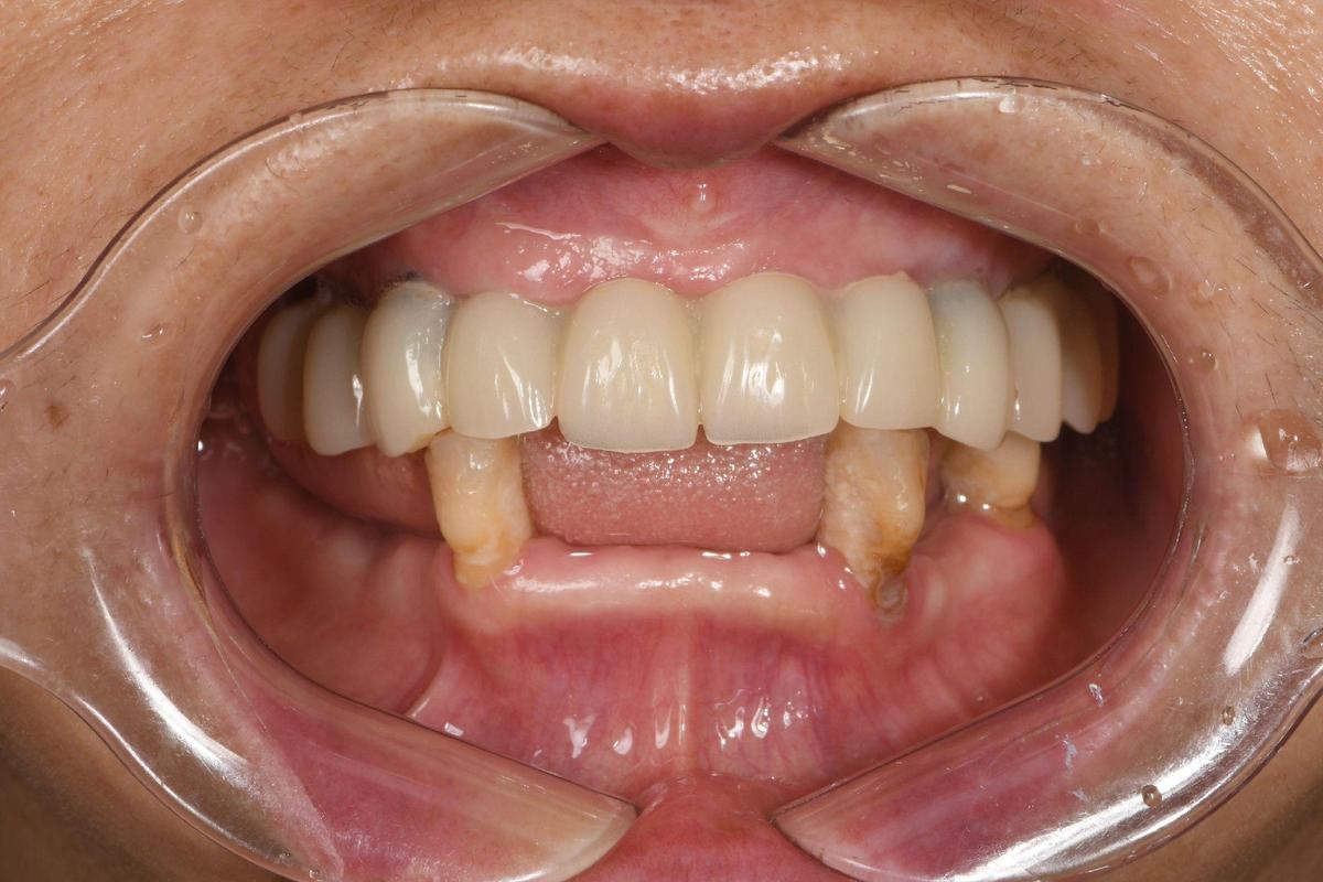 种植牙会导致下巴发紫吗?-图3 种植牙会导致下巴发紫吗?-图3