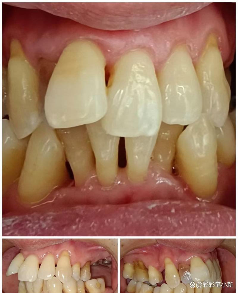 重度牙周炎缺失牙，种植牙可行吗？需先治牙周炎吗？-图1