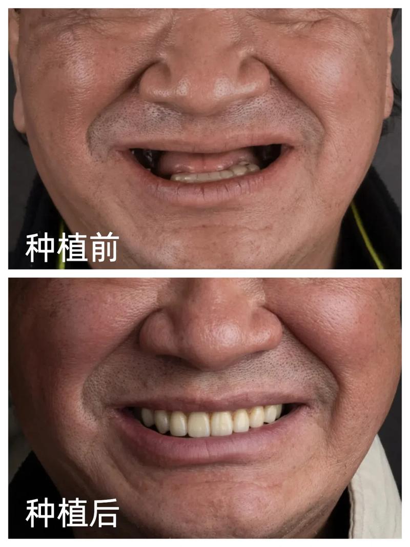 全国种植牙案例库，海量真实案例如何帮患者预见种植效果与风险？-图2