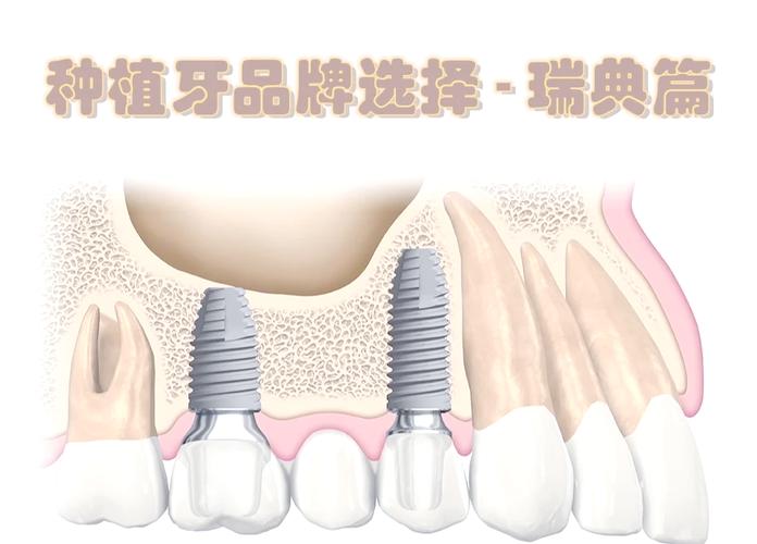 瑞典最久种植牙寿命有多长?技术优势何在?-图1 瑞典最久种植牙寿命有多长?技术优势何在?-图1