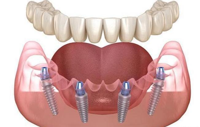 瑞典最久种植牙寿命有多长?技术优势何在?-图2 瑞典最久种植牙寿命有多长?技术优势何在?-图2