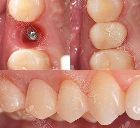 瑞典最久种植牙寿命有多长?技术优势何在?-图3 瑞典最久种植牙寿命有多长?技术优势何在?-图3