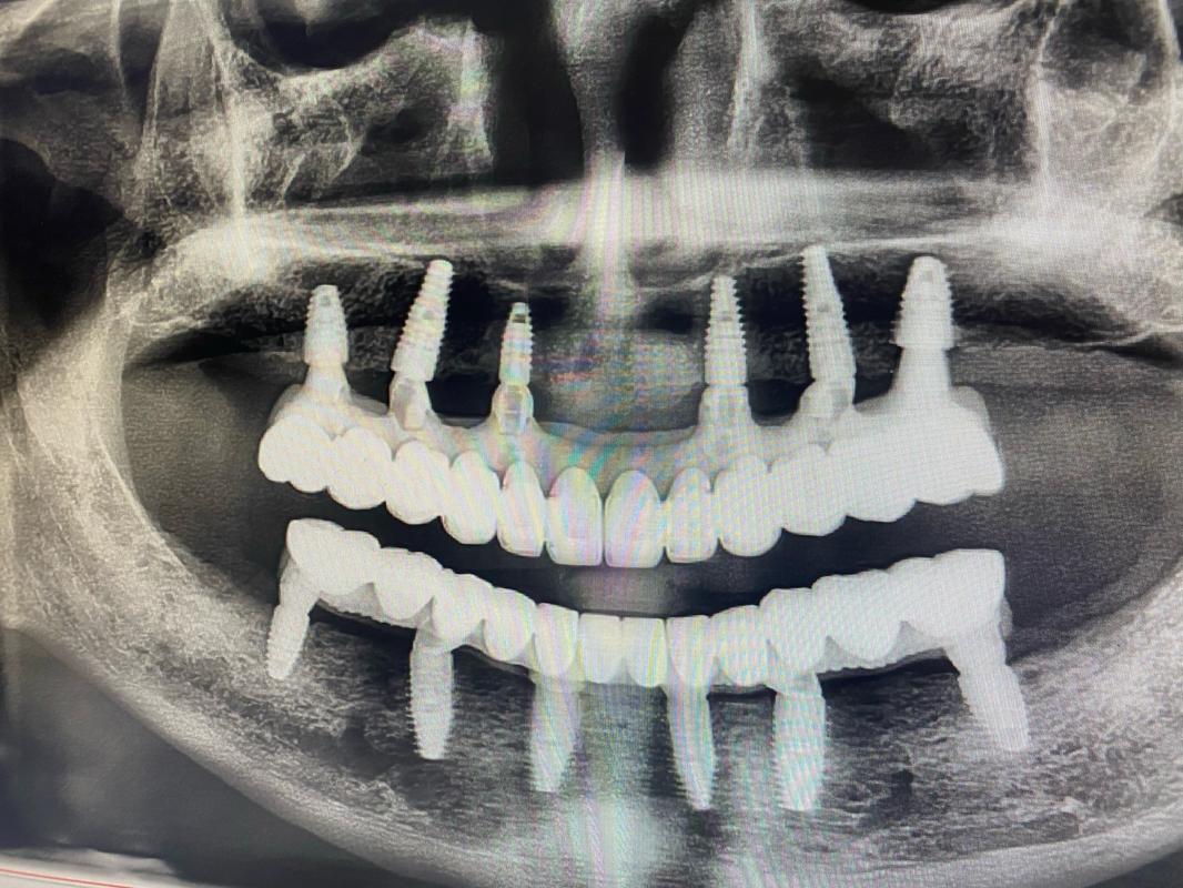 母亲节看种植牙图片，该不该作为健康礼物？-图2