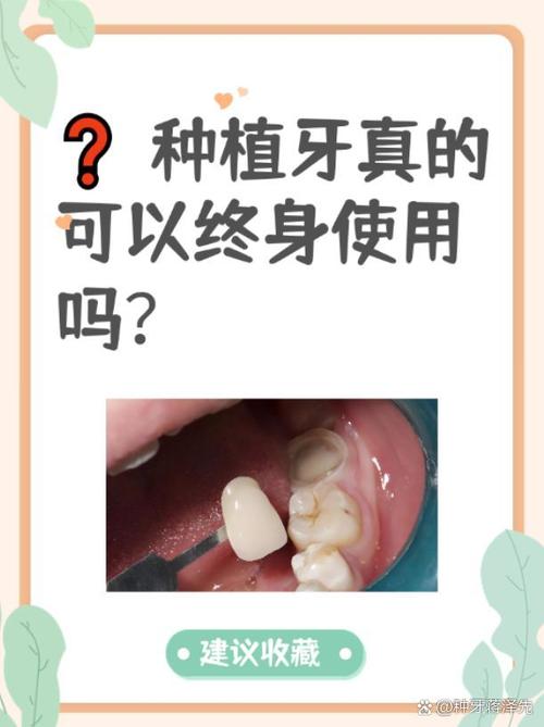 种植牙从术前检查到最终戴牙完成需要多长时间?-图2 种植牙从术前检查到最终戴牙完成需要多长时间?-图2