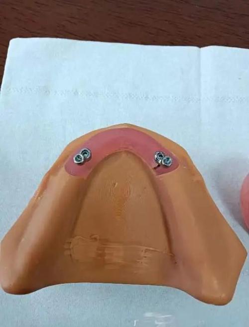 种植覆盖义齿牙适合哪些缺牙患者？效果如何维护？-图2