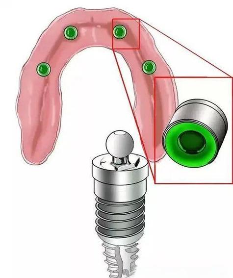 种植牙与固定义齿如何选？区别优缺点对比？-图2
