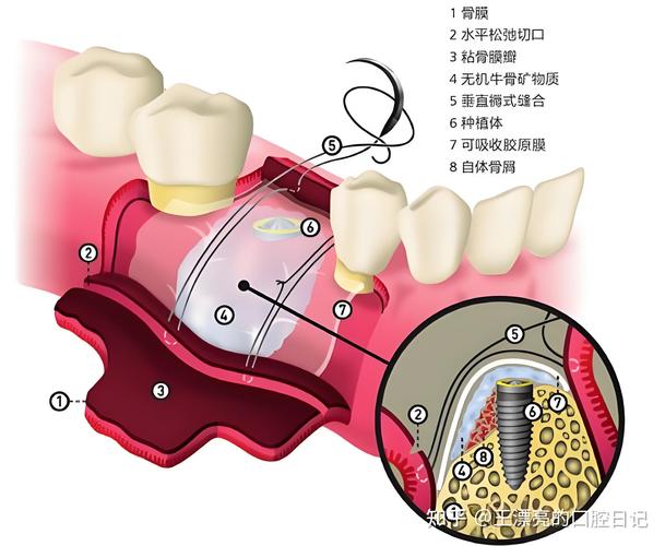 种植牙植骨是什么意思？植骨对种植牙到底有何作用？-图1