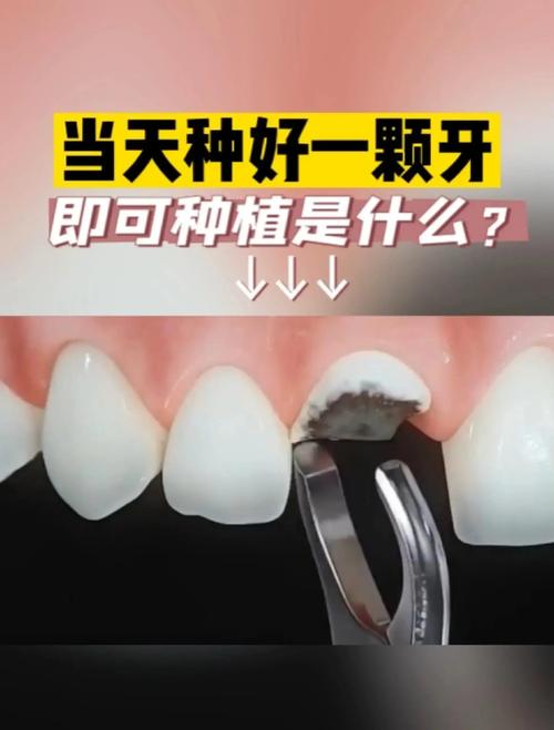 拔牙即刻种植 牙 青岛-图1 拔牙即刻种植 牙 青岛-图1