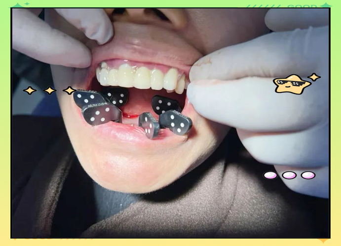 拔牙即刻种植 牙 青岛-图3 拔牙即刻种植 牙 青岛-图3