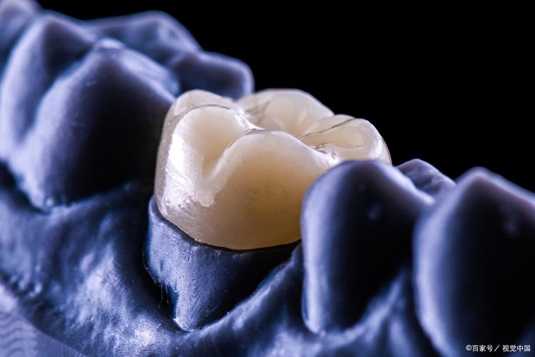 半口种植烤塑牙是什么？效果如何？有哪些注意事项和优势？-图1