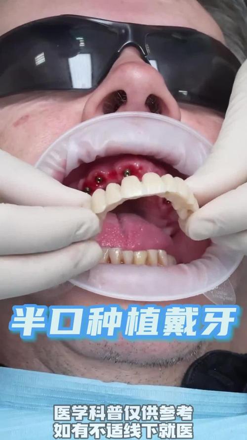 半口种植烤塑牙是什么？效果如何？有哪些注意事项和优势？-图2