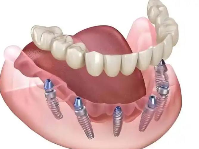 半口种植烤塑牙是什么？效果如何？有哪些注意事项和优势？-图3
