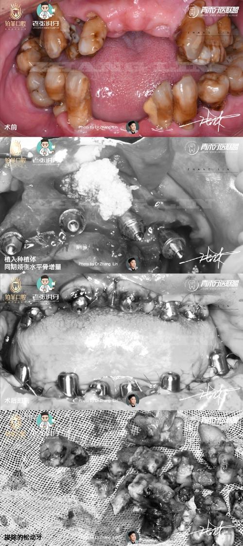 Bicon种植牙术后可能出现哪些并发症？-图2