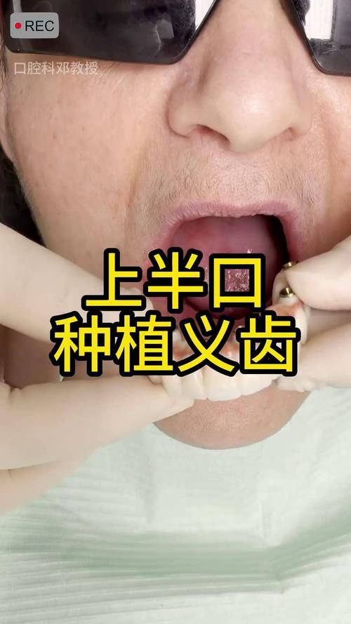 半口牙缺失做种植牙的流程是怎样的？步骤和注意事项有哪些？-图3