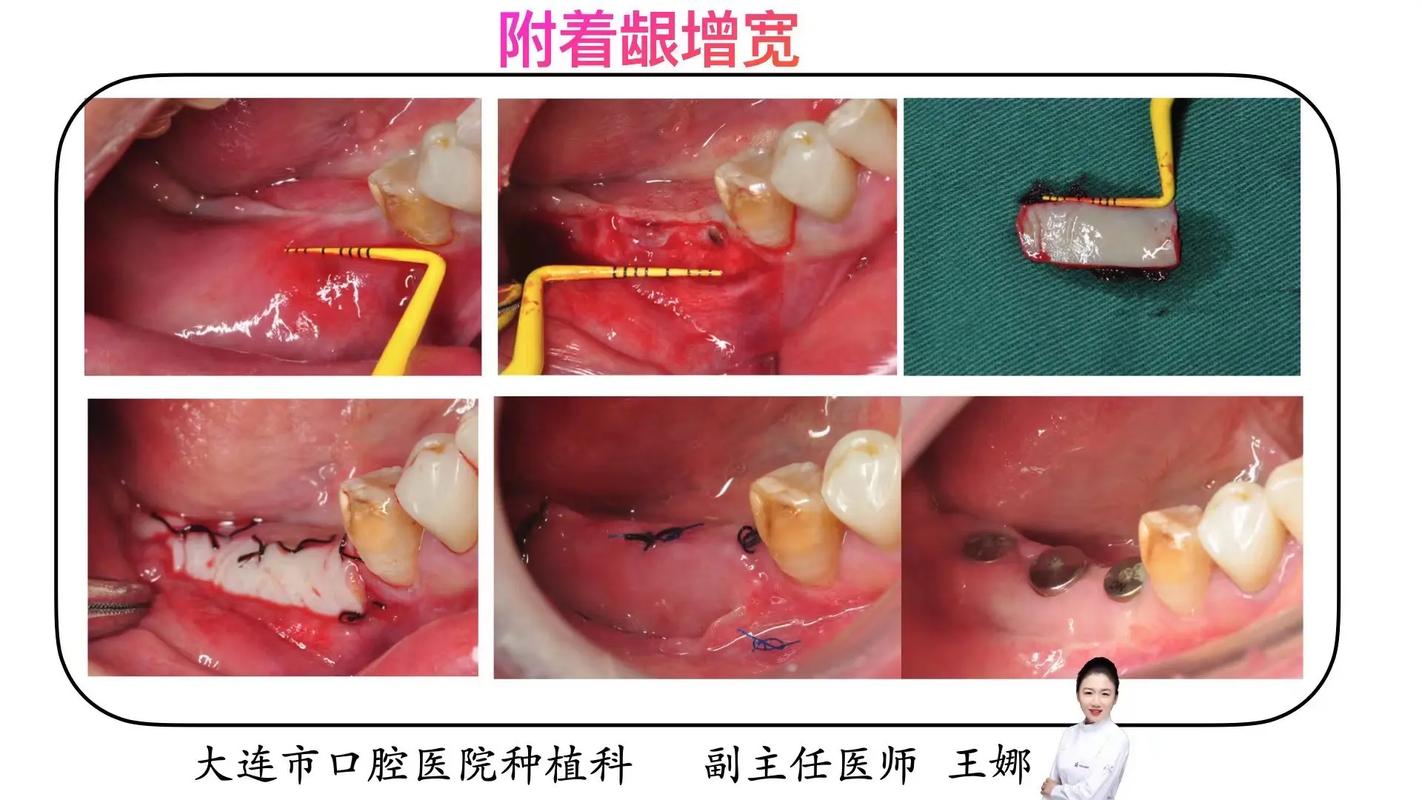 大连种植牙哪家机构实力最强？-图3