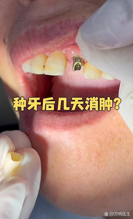 种植牙后疼痛怎么办?是正常现象吗?-图1 种植牙后疼痛怎么办?是正常现象吗?-图1